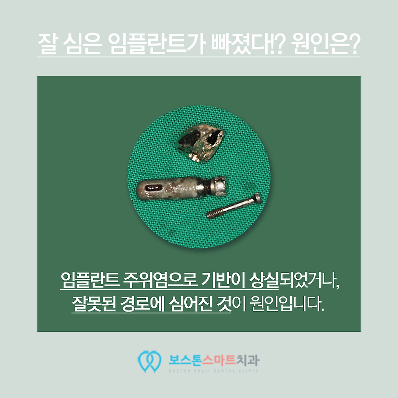 임플란트가 빠졌어요! 임플란트 빠짐 해결방법은?