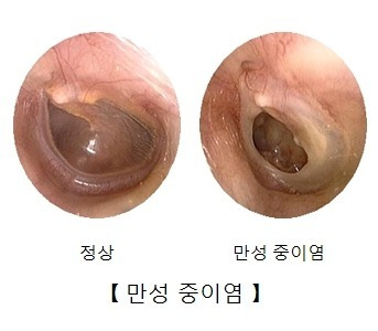 외이도염 증상과 치료! 외이도염 자연치유가 가능한가?