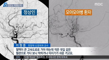 모야모야병 개그맨 강도 여모씨 누구? :: ✔알고 잘살자