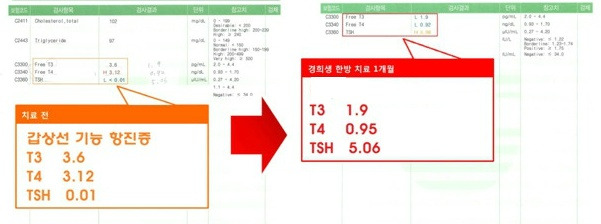 또한 정기적인 검사로 갑상선의 상태를 확인하는 것이 갑상선 질환 예방에 큰 도움이 됩니다