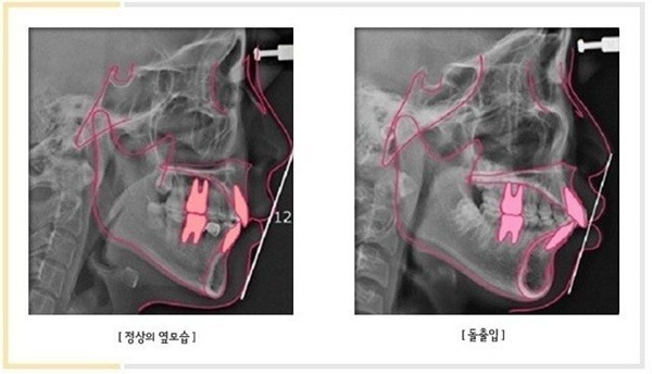 이빨교정 전후 사진을 살펴볼까요?