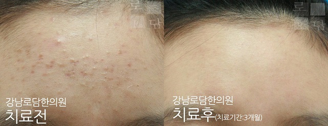 자꾸 생기는 이마에 좁쌀여드름, 어떻게 관리해야 하나요?