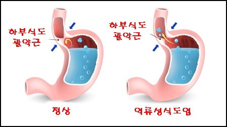 역류성식도염에 좋은 음료 두가지와 역류성 식도염에 나쁜 음료 다섯가지