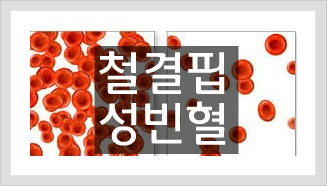 철 결핍성 빈혈 증상과  빈혈에 좋은 음식. 안좋은 음식 | 효능백과