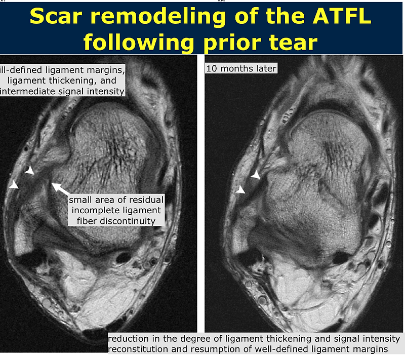 Lateral Ankle Ligament Complex, ATFL, CFL, PTFL