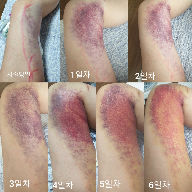 무한람스/허벅지] 시술당일 부터 9일차 후기(멍 변화)
