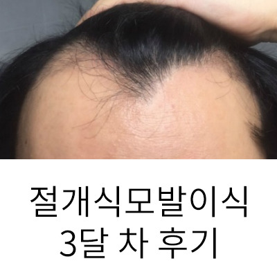 절개식 모발이식 3개월 후 암흑기의 끝물 (대전 연세모벨르)