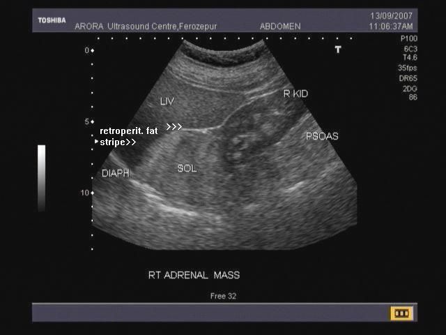 Fetal Adrenal Glands Ultrasound