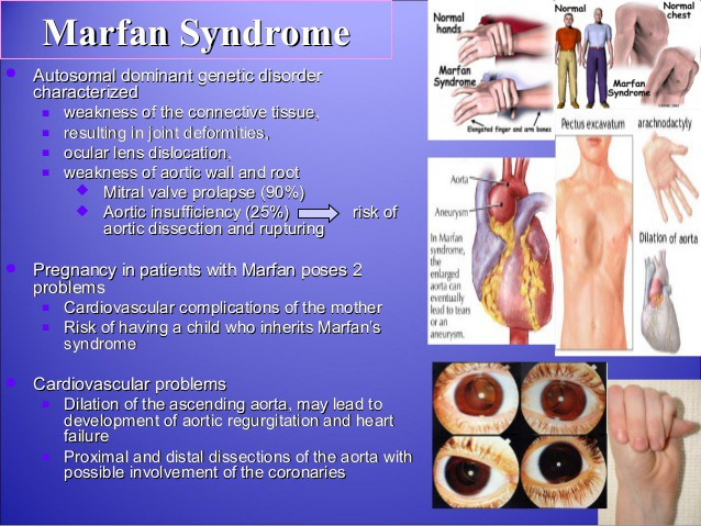 Marfan Syndrome