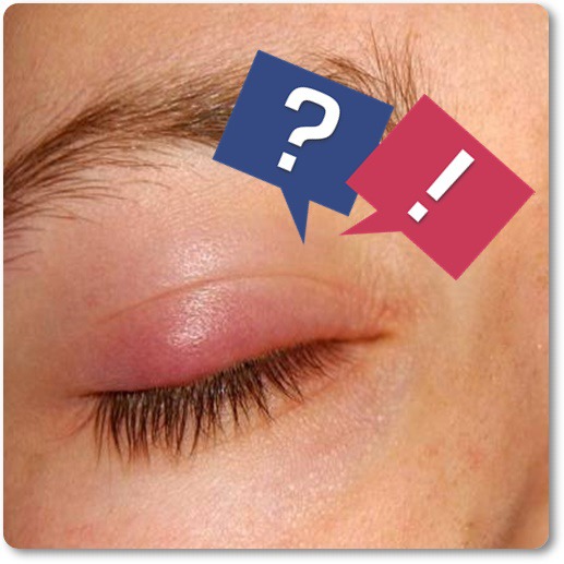 눈두덩이 부어오름 원인과 치료방법 알아보기