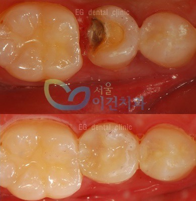 치아깨짐, 치아구멍 치과치료 어떻게 할까?