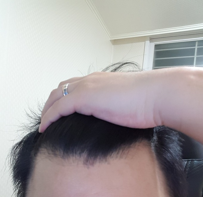 핀페시아 다이렉트로 구매해서 만든 탈모관리 후기 12