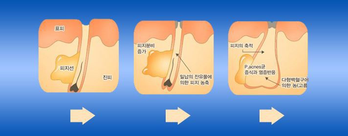 완벽한 여드름 치료법? 로아큐탄과 비타민A