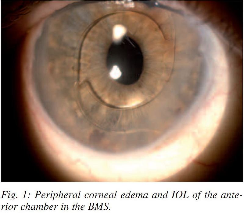 백내장 수술, 렌즈삽입술(ICL)이후 발생하는 주변부 각막 부종, 합병증, 부작용 : Brown McLean syndrome