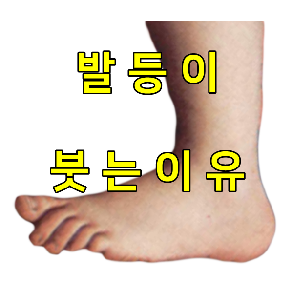 발등이 붓는 이유 원인 알아보기