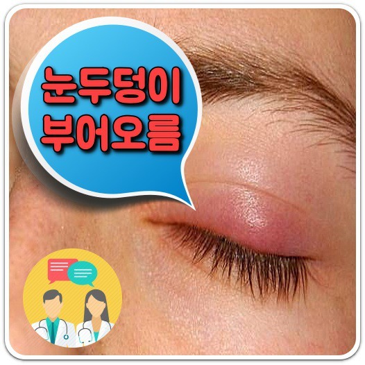 눈두덩이 부어오름 증상 원인/치료방법, 의학정보 톡톡!!