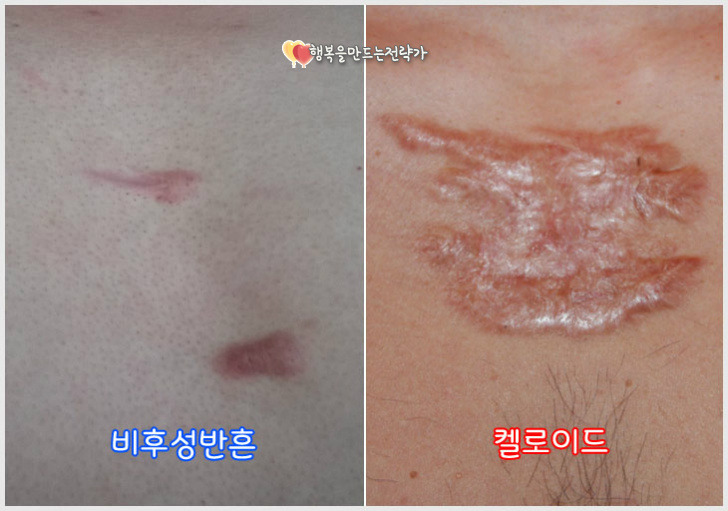 켈로이드 흉터? 비후성 반흔? 공통점과 차이점에 대해서 알아보겠습니다.