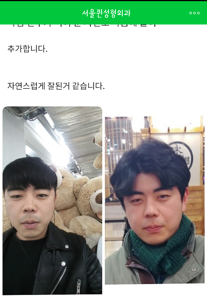 남성을 위한 코성형 리뷰 – 코성형 비용 vs. 코축소 전후 6