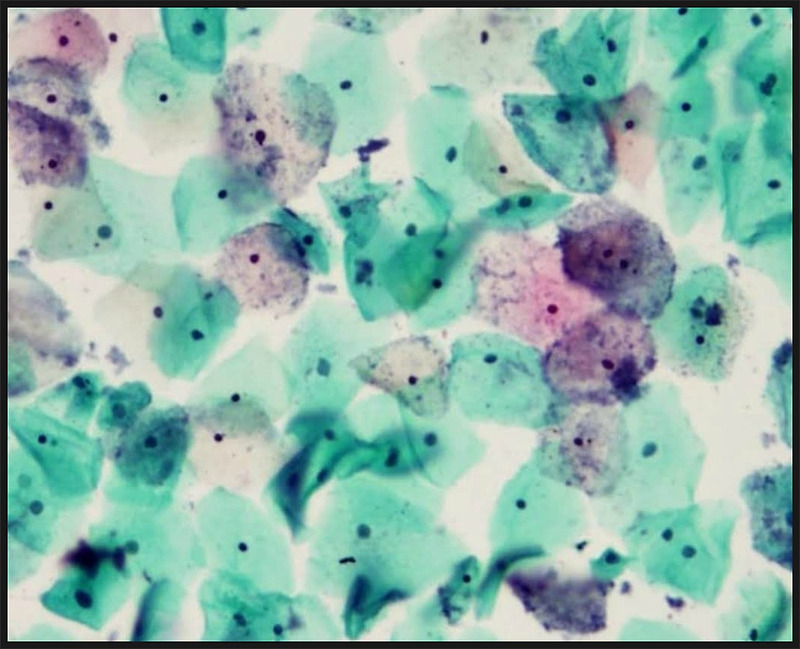 비뇨기질환 완전정복9장- 성병균! 가드넬라 바지날리스(Gardnerella vaginalis)의 모든것