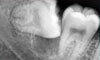 치아건강을 위한 공간 :: 턱관절이 아픈게 사랑니 때문일까? (사랑니턱관절 많이 묻는질문)