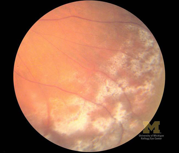 눈에 눈이 내리면 눈송이 유리체 망막 변성 Snowflake Vitreoretinal Degeneration Svd