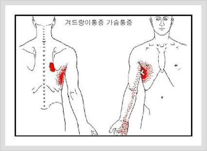 Nice to meet You :: 왼쪽 겨드랑이 통증의 원인