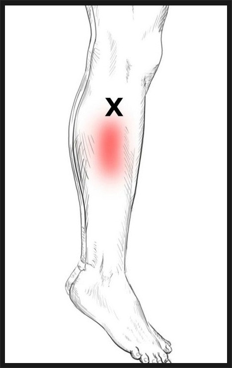 비골근 건초염 통증 강화 운동 peroneal muscle