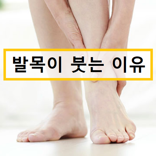 발목이 붓는 이유 :: 피지컬 스토리