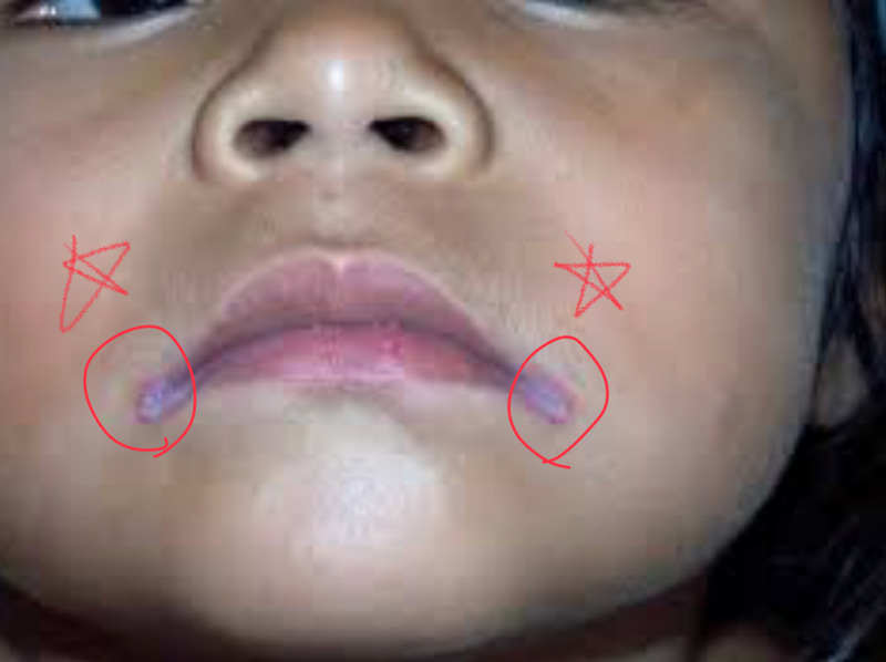구순구각염(angular cheilitis) 특징 정리
