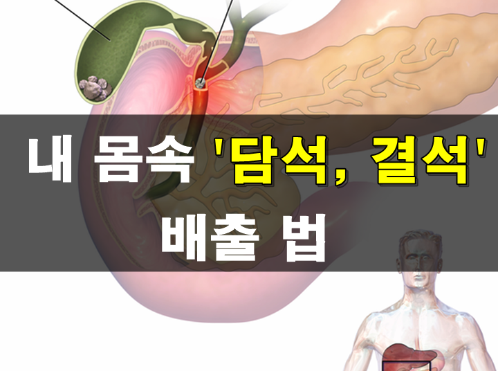 내 몸속 담석, 결석 배출법 :: 건강한생활