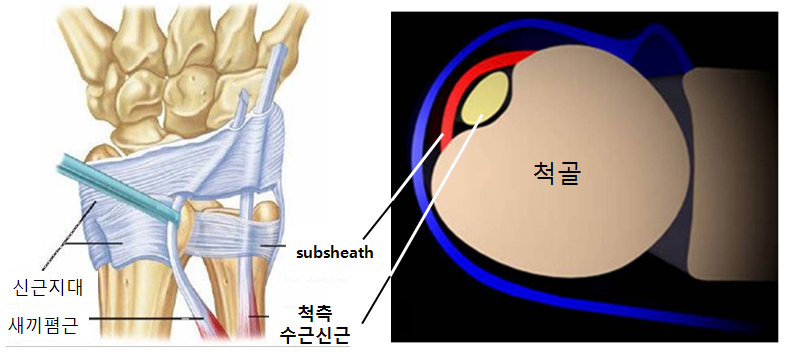 닥터 배의 의학정보★ :: 손목의 통증 (2) :: 척측수근신근 건염 (힘줄염)