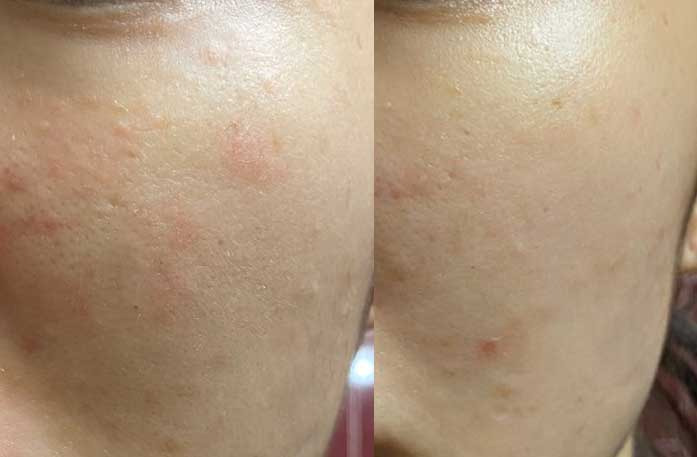 비판텐 연고, 얼굴 여드름에 쓴대. 비판텐 연고, 얼굴 여드름에 쓴대.