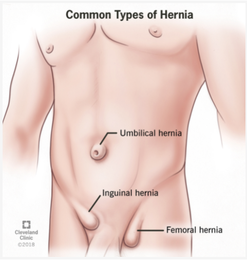 Inguinal hernia (서혜부탈장;사타구니탈장) :: BioinformaticsAndMe