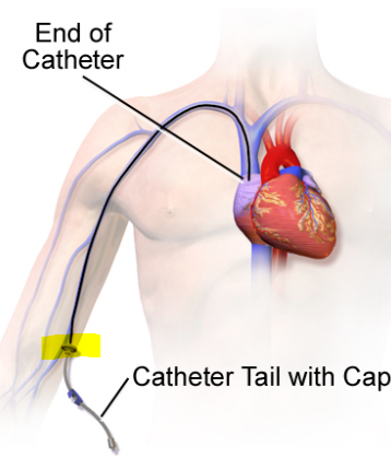 중심정맥관 종류 (C-line, central venous catheter, CVC, 카테터, PICC, 히크만, Hickman, Broviac, 브로비악, chemoport, 케모포트, 터널) (관리, 합병증)
