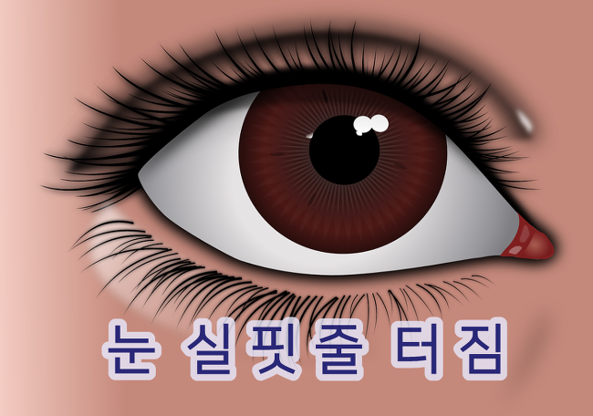 눈 실핏줄 터짐 원인과 증상, 없애는 방법 알아보기