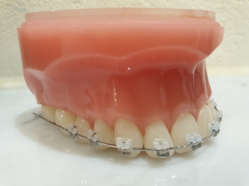 치아교정장치 종류는 어떻게 되나요?