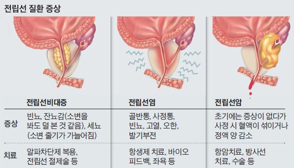 a prostatitis ureteritát okoz