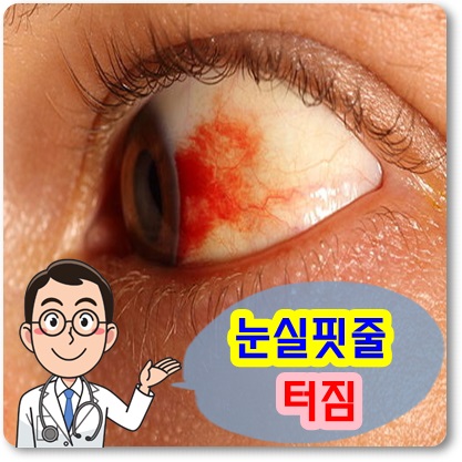 눈 실핏줄 터짐 제거방법 및 방치 시 위험성