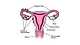 출처: Endometriosis UK