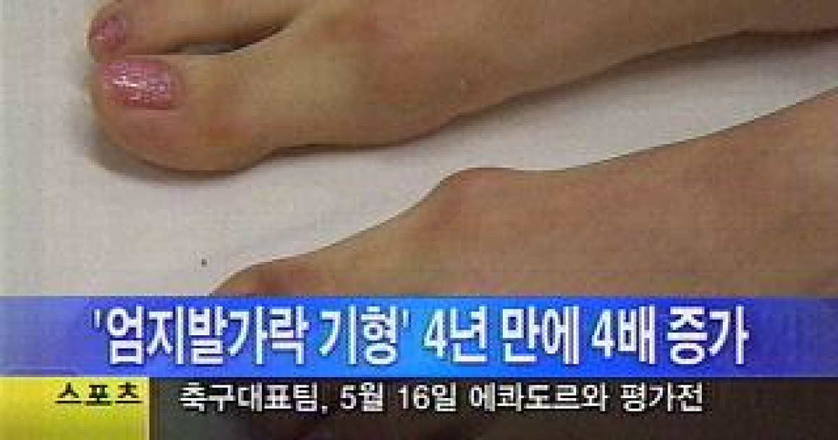 '엄지발가락 기형' 증가..87%가 여성