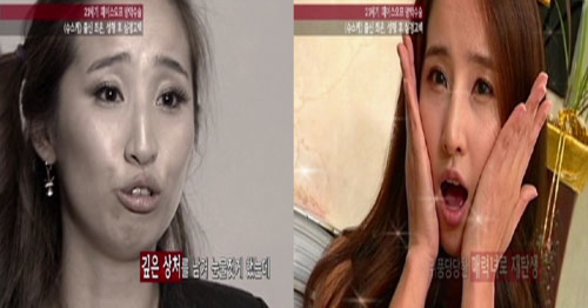 '슈스케2' 에로배우 최은, 양악수술후 모습 공개
