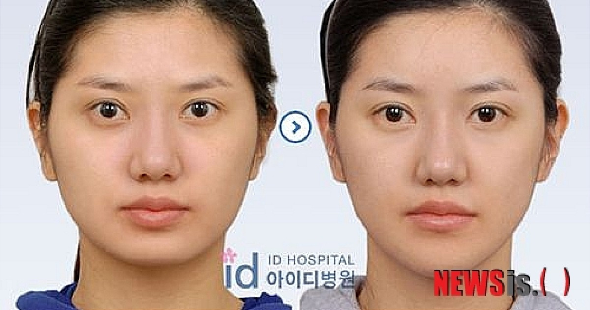 V라인 턱 선의 비결..'미니V라인 앞턱수술'