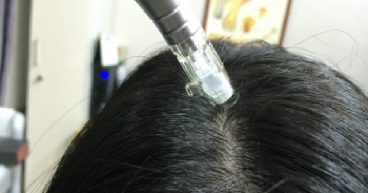 다이어트로 잃은 머리카락, 'HORP 줄기세포 재생치료'로 되돌린다
