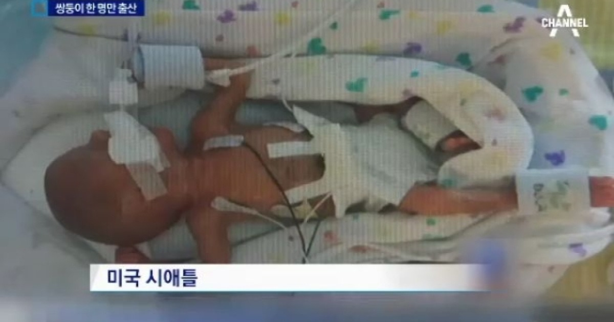 일란성 쌍둥이 동생은 넉 달 뒤 출산..무슨 일?