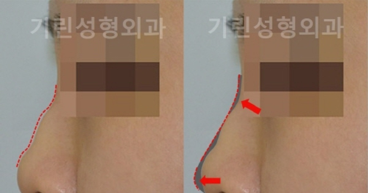 무보형물코성형복비의원인을하나씩제거하자 4