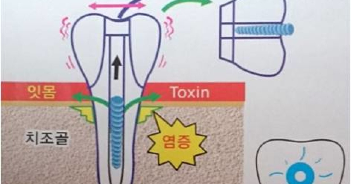 뼈 이식수술 하지 않아도 되는 원바디 임플란트