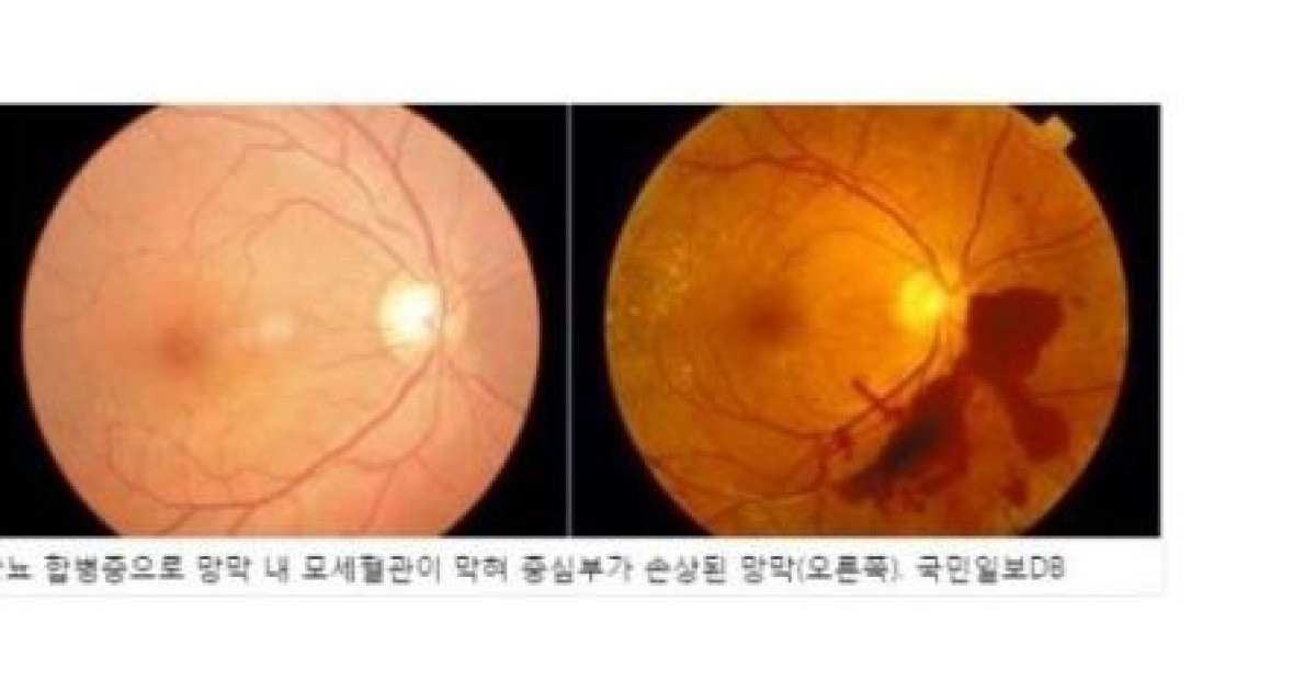 잠 부족한 남성, 실명 초래 '당뇨 망막증' 위험 높다