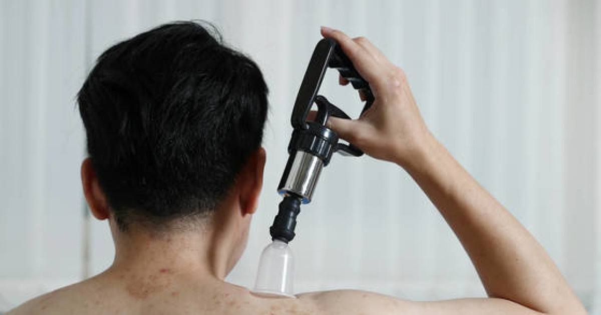 [건강한 당신] 집에서 부항 뜨다 피부염 .. 의료기기, 몸 상태 따라 골라 써야