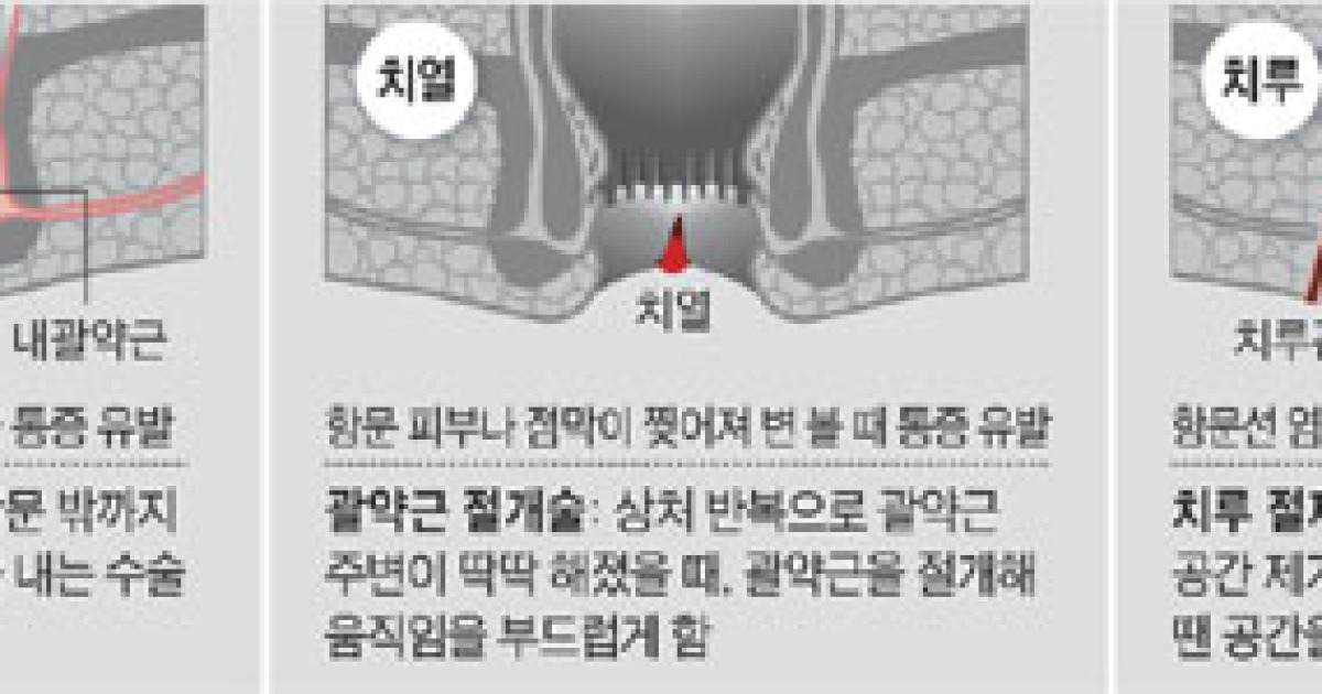 항문에 혹 생기는 치핵.. 앉을 때 통증 심하면 수술해야