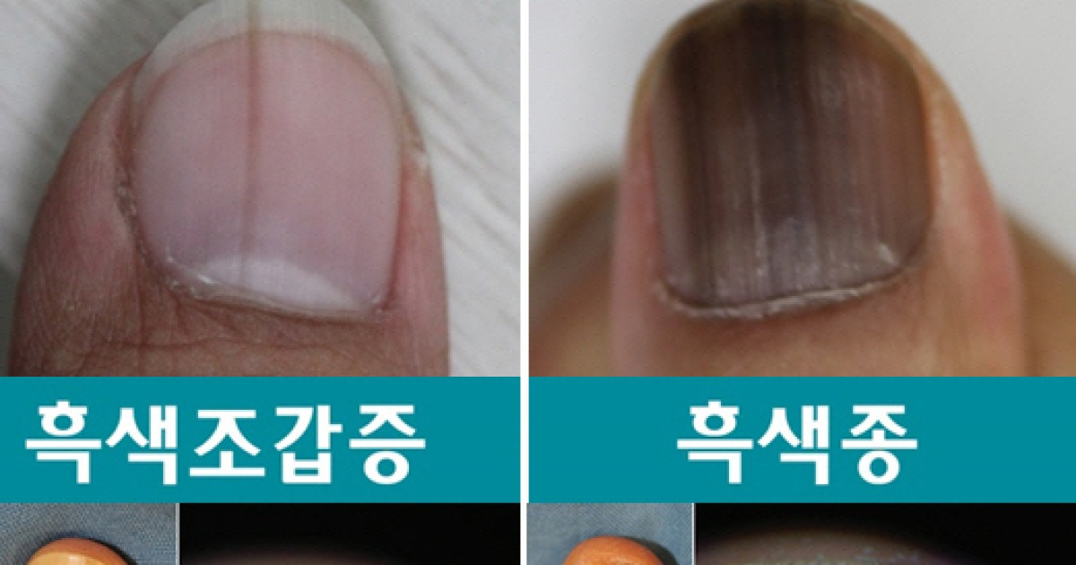 손발톱 흑색·갈색선 폭 3mm 이상·색조 다양하면 '흑색종 의심할만'
